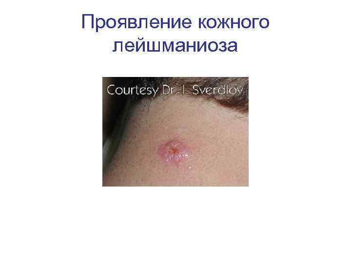 Проявление кожного лейшманиоза 