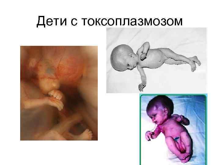 Дети с токсоплазмозом 