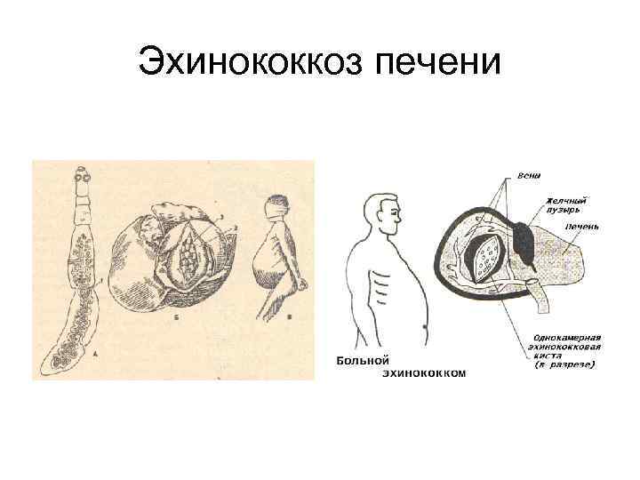 Эхинококкоз печени 