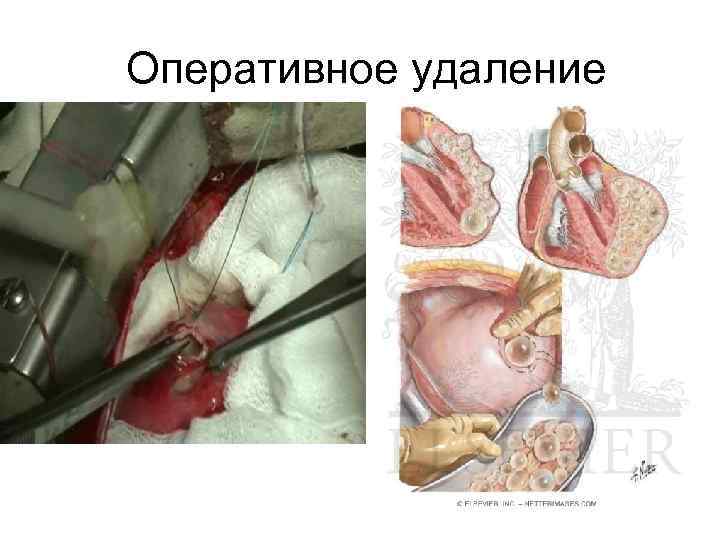  Оперативное удаление 