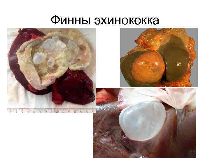 Финны эхинококка 
