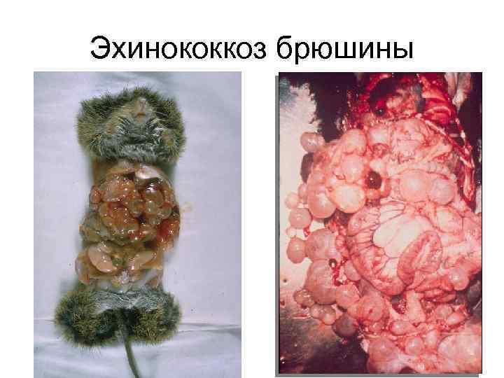 Эхинококкоз брюшины 