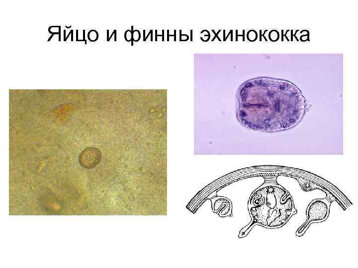 Схема эхинококковой кисты