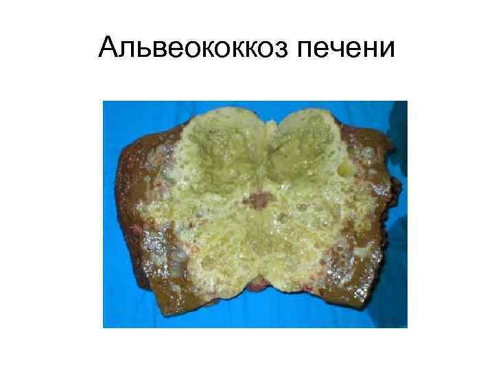 Альвеококкоз печени 
