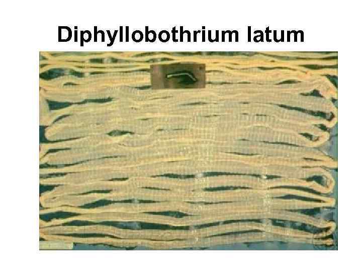 Diphyllobothrium latum 