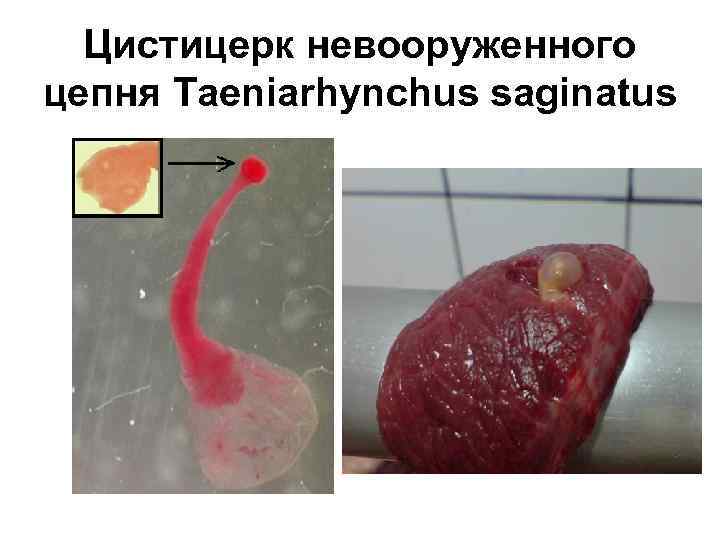 Цистицерк невооруженного цепня Taeniarhynchus saginatus 