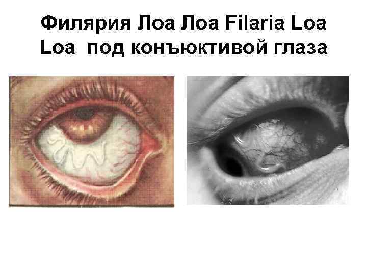 Филярия Лоа Filaria Loa под конъюктивой глаза 