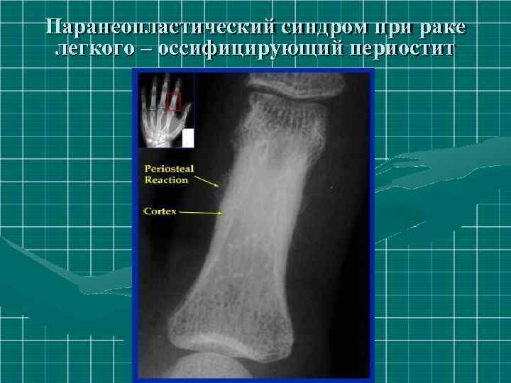 Паранеопластический синдром при раке легкого – оссифицирующий периостит 