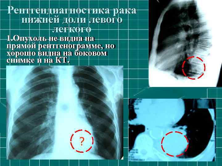 Рентгендиагностика рака нижней доли левого легкого 1. Опухoль не видна на прямой рентгенограмме, но