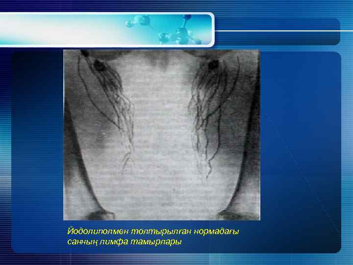 Йодолиполмен толтырылған нормадағы санның лимфа тамырлары 