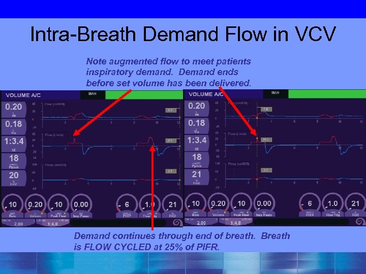 Intra-Breath Demand Flow in VCV Note augmented flow to meet patients inspiratory demand. Demand