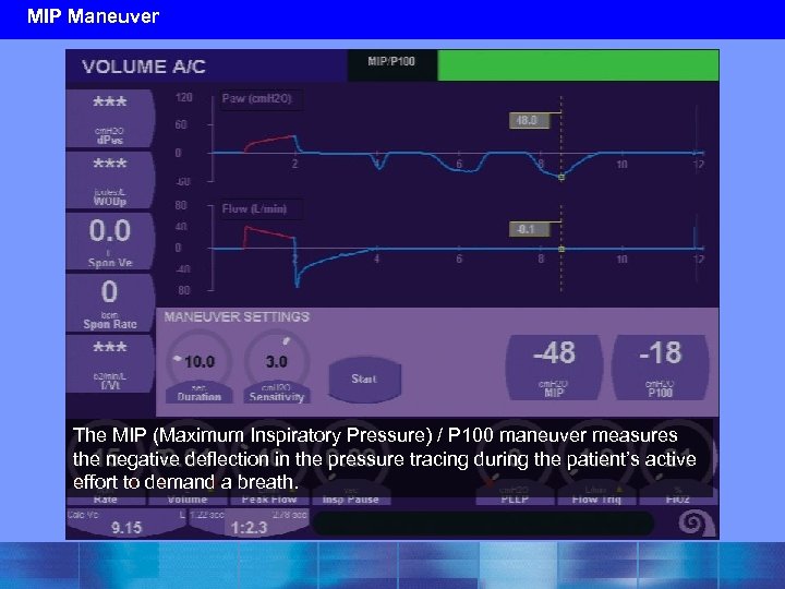 MIP Maneuver The MIP (Maximum Inspiratory Pressure) / P 100 maneuver measures the negative