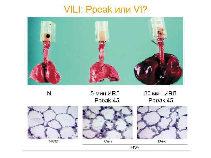 VILI: Ppeak или Vt? N 5 мин ИВЛ Ppeak 45 20 мин ИВЛ Ppeak