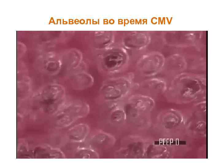 Альвеолы во время CMV 
