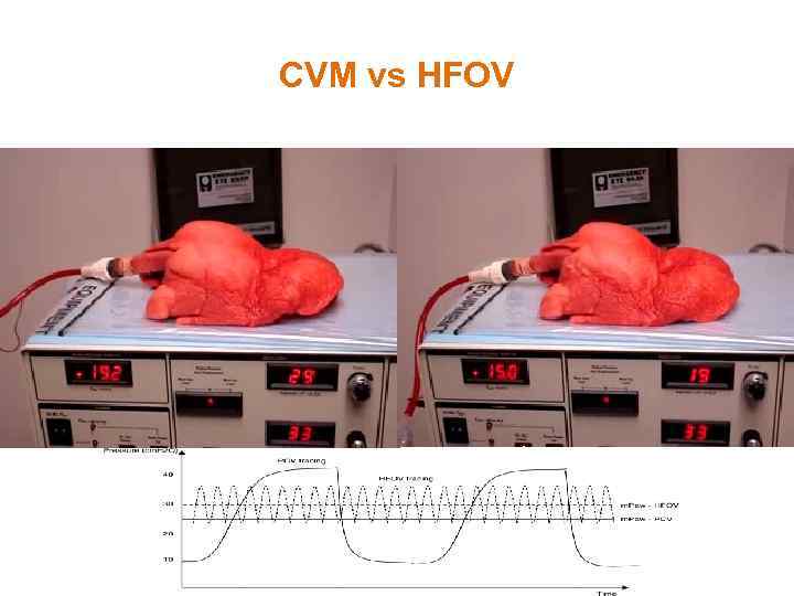 CVM vs HFOV 