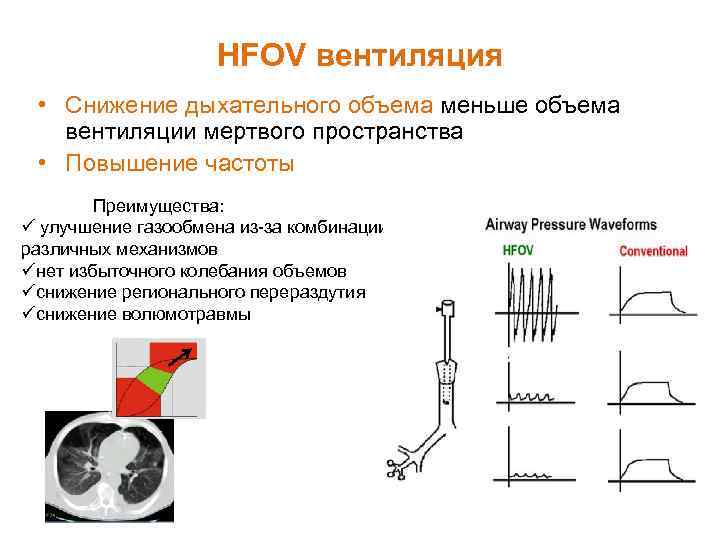 HFOV вентиляция • Снижение дыхательного объема меньше объема вентиляции мертвого пространства • Повышение частоты