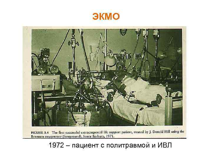 ЭКМО 1972 – пациент с политравмой и ИВЛ 