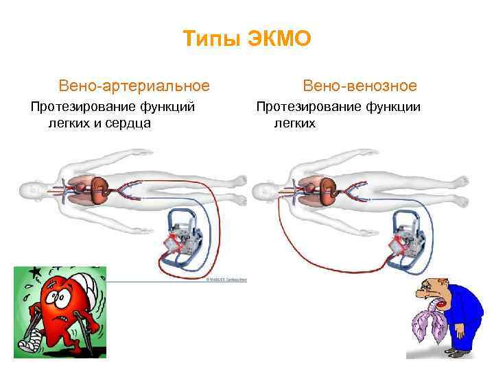 Типы ЭКМО Вено-артериальное Протезирование функций легких и сердца Вено-венозное Протезирование функции легких 