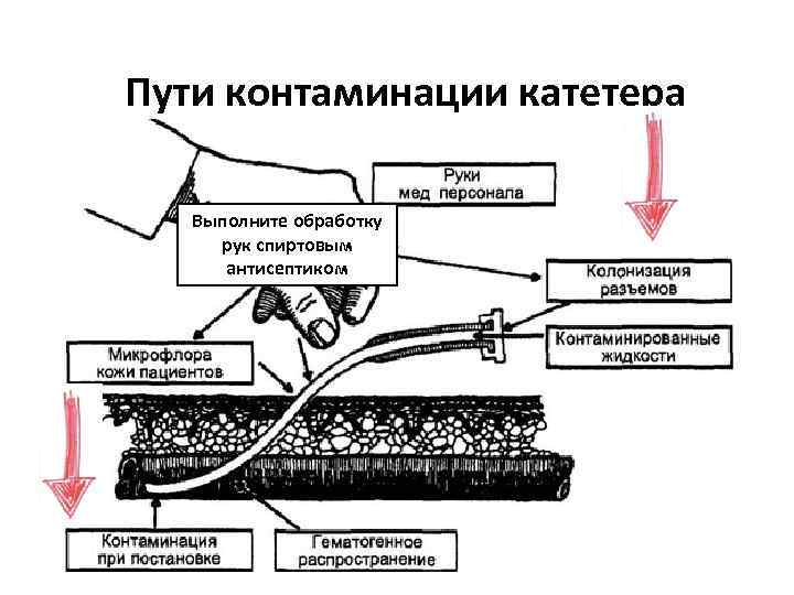 Пути контаминации катетера Выполните обработку рук спиртовым антисептиком 