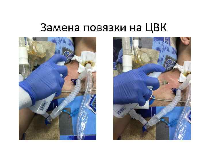 Замена повязки на ЦВК 