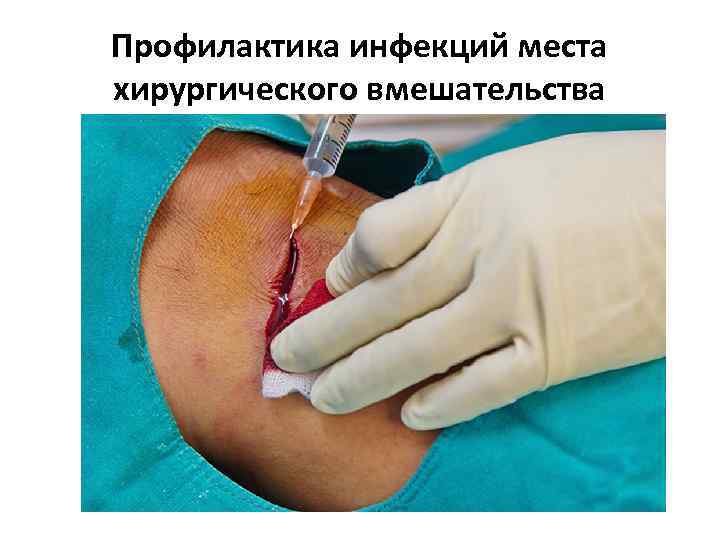 Профилактика инфекций места хирургического вмешательства 