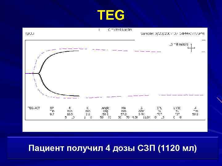 TEG Пациент получил 4 дозы СЗП (1120 мл) 