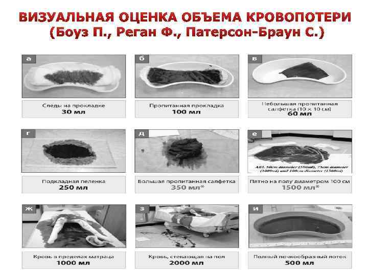ВИЗУАЛЬНАЯ ОЦЕНКА ОБЪЕМА КРОВОПОТЕРИ (Боуз П. , Реган Ф. , Патерсон-Браун С. ) 