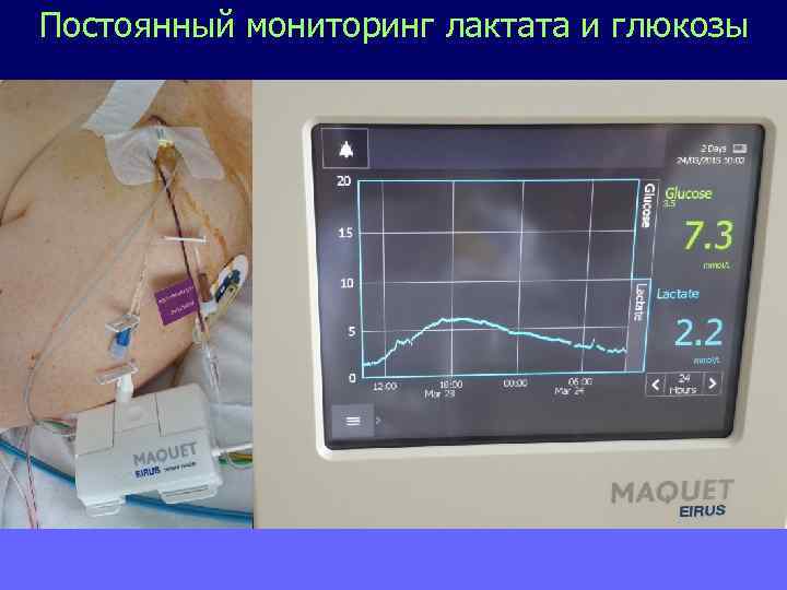 Постоянный мониторинг лактата и глюкозы 