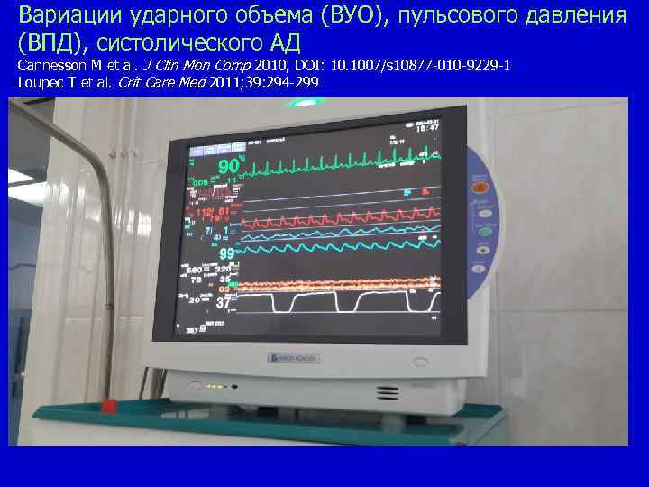 Вариации ударного объема (ВУО), пульсового давления (ВПД), систолического АД Сannesson M et al. J