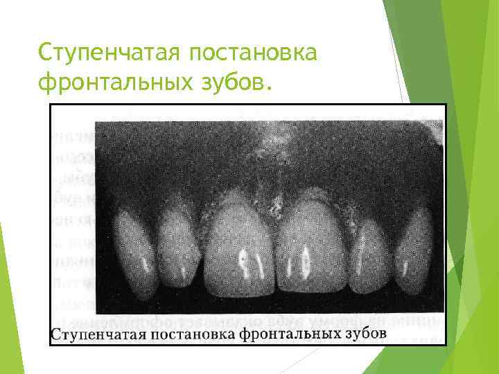 Ступенчатая постановка фронтальных зубов. 42 