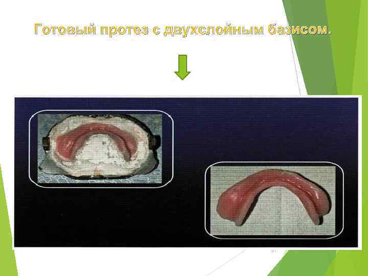 Готовый протез с двухслойным базисом. 81 