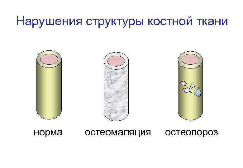 Нарушения структуры костной ткани норма остеомаляция остеопороз 