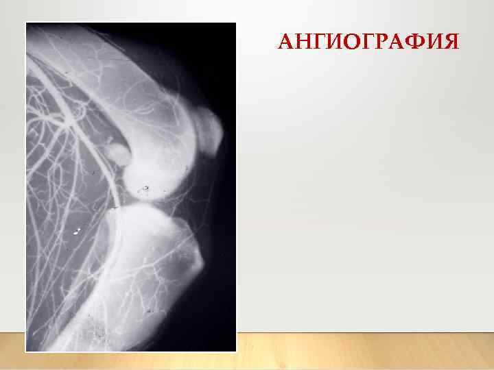 АНГИОГРАФИЯ 