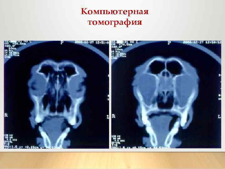 Компьютерная томография 