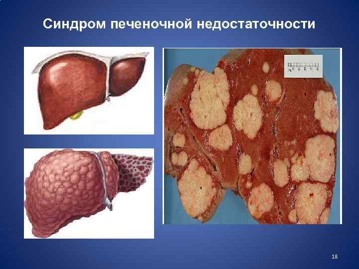 Синдром печеночной недостаточности 18 