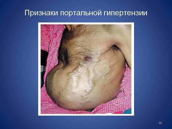 Признаки портальной гипертензии 25 