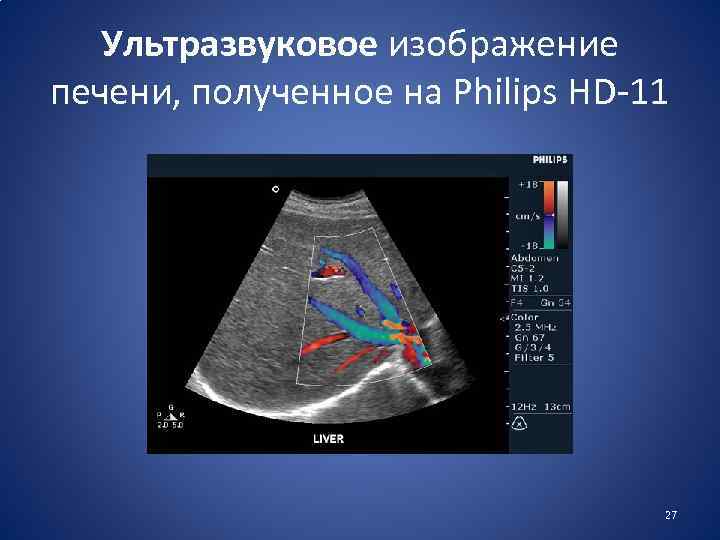  Ультразвуковое изображение печени, полученное на Philips HD-11 27 