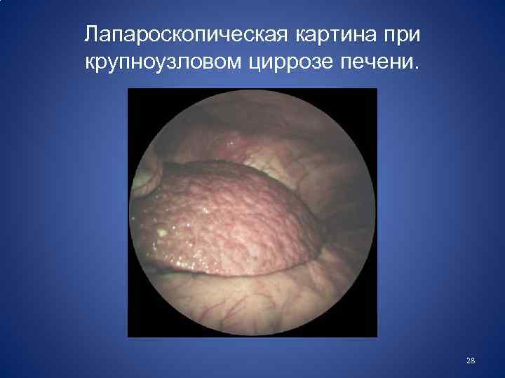 Лапароскопическая картина при крупноузловом циррозе печени. 28 