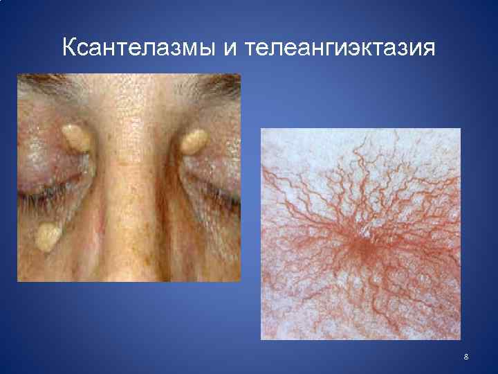 Ксантелазмы и телеангиэктазия 8 