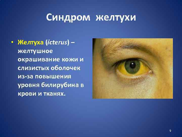 Синдром желтухи • Желтуха (icterus) – желтушное окрашивание кожи и слизистых оболочек из-за повышения