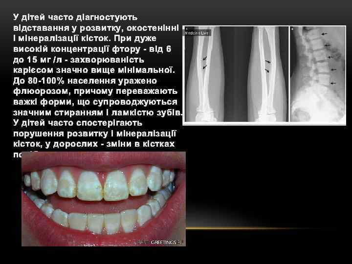 У дітей часто діагностують відставання у розвитку, окостенінні і мінералізації кісток. При дуже високій