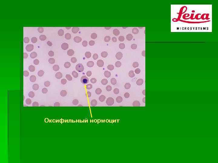 Нормоцит это. Полихроматофильный нормоцит. Оксифильные нормоциты. Оксифильный нормоцит в крови. Нормоцит оксифильный полихроматофильный это.