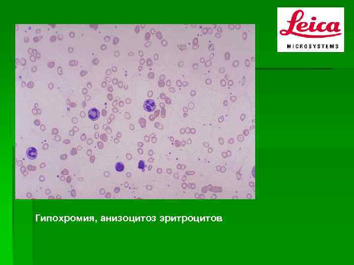 Анизоцитоз эритроцитов. Гипохромия анизоцитоз. Анизоцитоз пойкилоцитоз гипохромия. Гипохромия анизоцитоз микроцитоз. Гипохромия эритроцитов у взрослого.