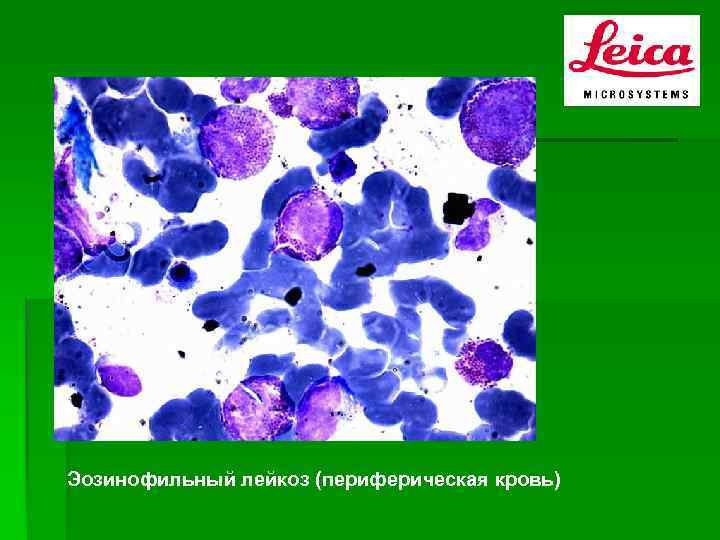 Эозинофильный лейкоз (периферическая кровь) 