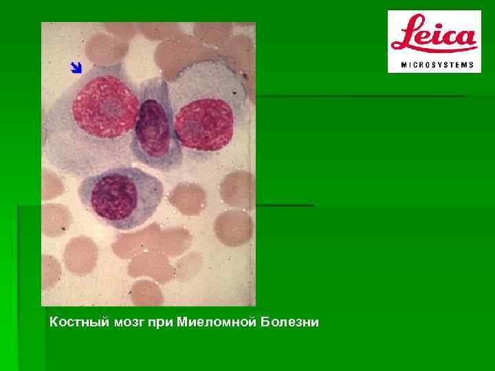 Костный мозг при Миеломной Болезни 