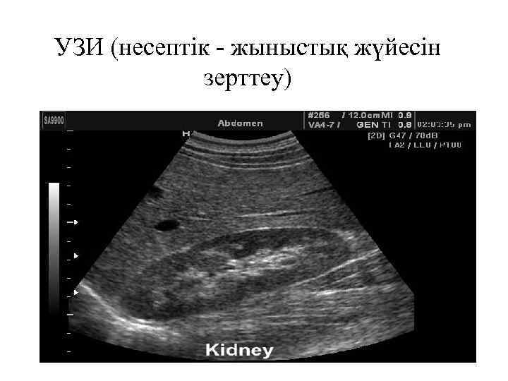 УЗИ (несептік - жыныстық жүйесін зерттеу) 