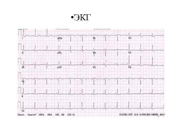  • ЭКГ 