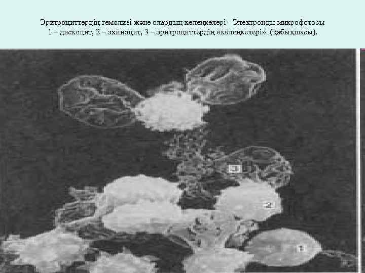 Эритроциттердің гемолизі және олардың көлеңкелері - Электронды микрофотосы 1 – дискоцит, 2 – эхиноцит,