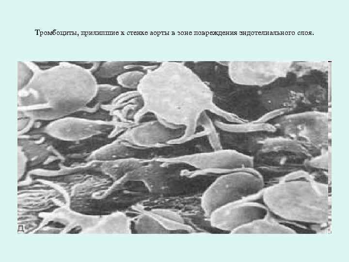 Тромбоциты, прилипшие к стенке аорты в зоне повреждения эндотелиального слоя. 