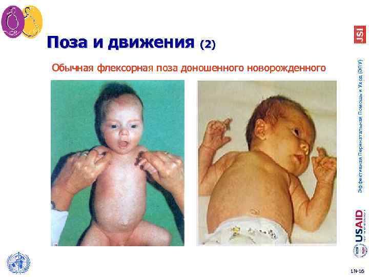Обычная флексорная поза доношенного новорожденного Эффективная Перинатальная Помощь и Уход (ЭПУ) Поза и движения